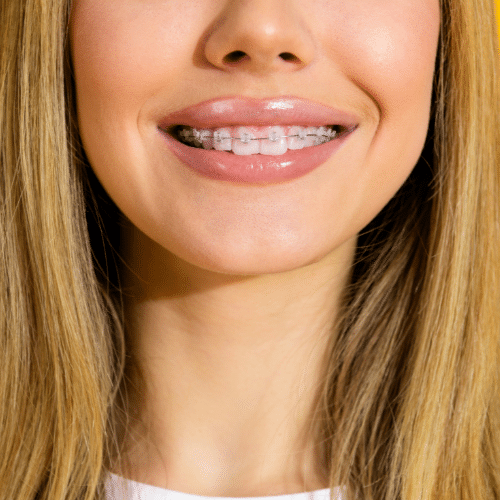 Woman smiling with braces close-up portrait | Kania and Khan Orthodontics in Asheboro, NC