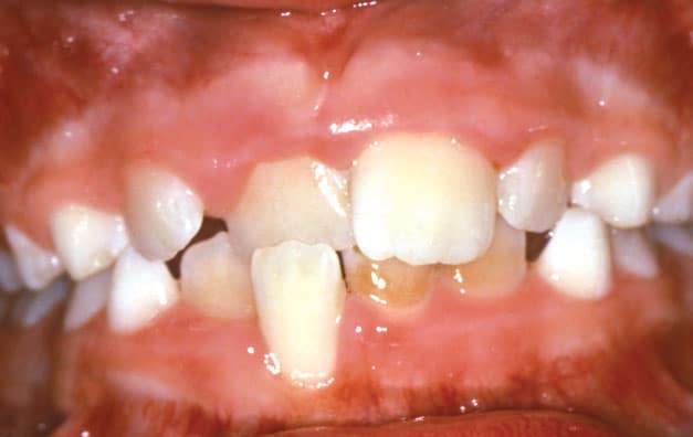 Close-up of crowded lower teeth interior view | Kania and Khan Orthodontics in Asheboro, NC