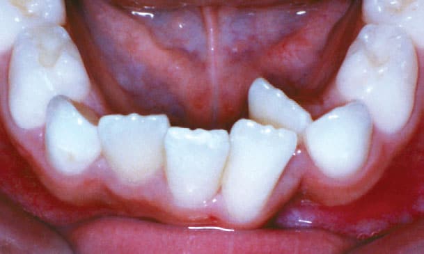 Close-up of child upper teeth and gum line | Kania and Khan Orthodontics in Asheboro, NC