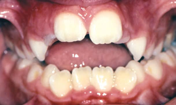 Close-up of teeth showing gap and alignment | Kania and Khan Orthodontics in Asheboro, NC