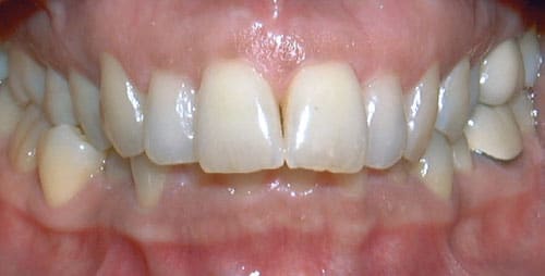 Close-up of upper teeth with spacing issues | Kania and Khan Orthodontics in Asheboro, NC