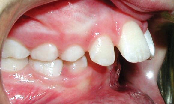 Close-up of lower teeth and gum tissue | Kania and Khan Orthodontics in Asheboro, NC
