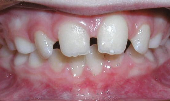 Close-up of child teeth with gap front teeth | Kania and Khan Orthodontics in Asheboro, NC