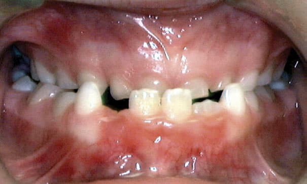 Open mouth close-up showing missing baby teeth | Kania and Khan Orthodontics in Asheboro, NC