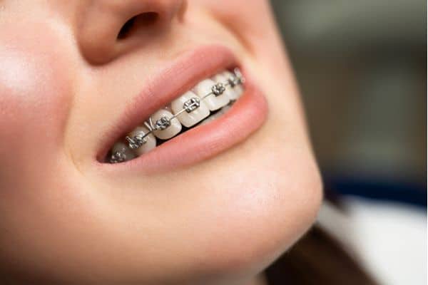 Close-up of metal braces on patient teeth in Asheboro, NC