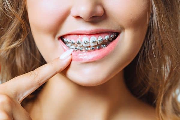 Woman smiling pointing to metal braces in Asheboro, NC